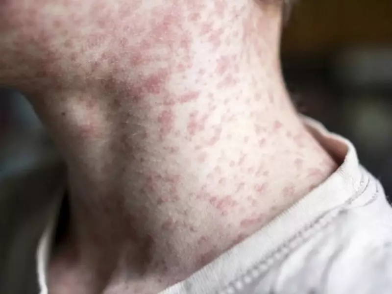 Canada Loses Measles Elimination Status: Vaccine Hesitancy Blamed