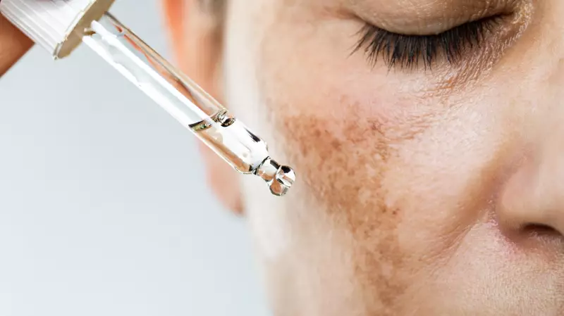 Dermatologists Reveal: The Ultimate Guide to Banishing Melasma for Good