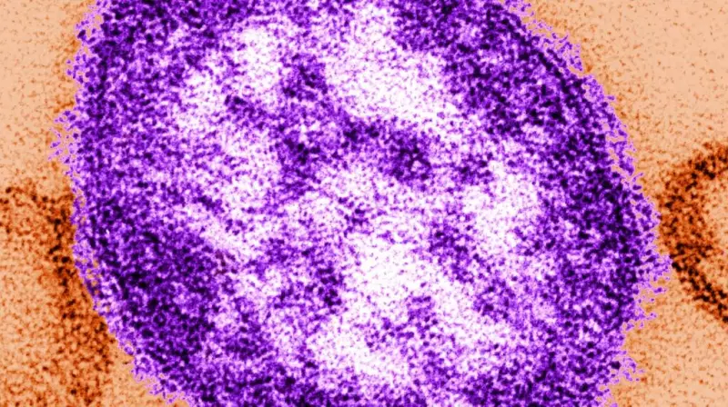 Measles Exposure Sites Identified in Morden and Winkler, Manitoba