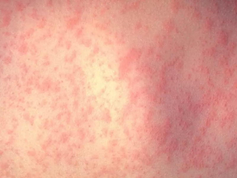 Measles Outbreak in Quebec: Montreal Confirms First Case, Total Rises to 7