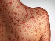 Alberta Reports Single Active Measles Case After 2025 Outbreak of 2,000