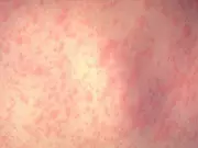 Measles Outbreak Expands: Montreal Confirms First Case as Quebec Total Hits 7