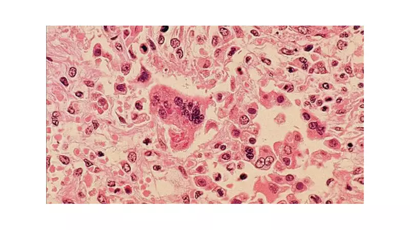 Measles Alert in Winnipeg: Manitoba Health Identifies New Exposure Locations