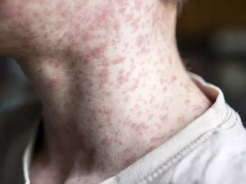 Measles Outbreak in Alberta Reaches 2,042 Cases, Public Alert Issued for Edmonton Hospital