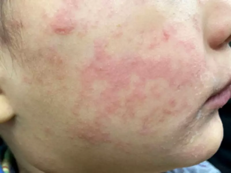 Ontario Experts Urge Measles Immunization Action Plan After Outbreak