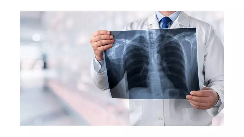 Pneumonia Deaths Surge 20% in Canada, New StatCan 2024 Data Reveals