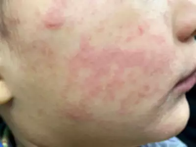 Ontario Experts Urge Measles Immunization Action Plan After Outbreak