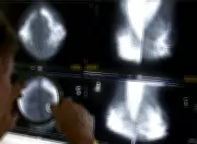 AI System HealthNews ServiceAI Aids Radiologists in Breast Cancer Detection in Pioneering Global Trial