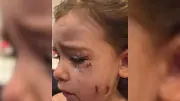 Oshawa Moms Recount Terrifying Dog Attack That Left Four-Year-Old Girl with Facial Injuries