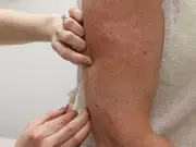 Quebec Measles Outbreak Grows to 11 Confirmed Cases, Montreal Children's Hospital Exposure