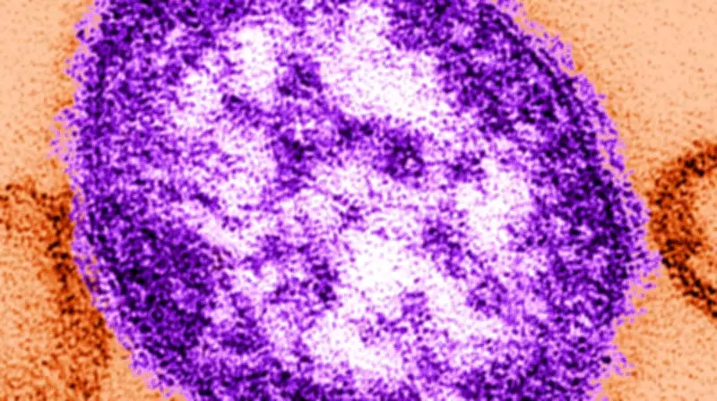 Measles Cases Surge in Manitoba, Officials Issue Exposure Warning