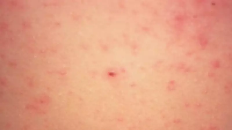 Measles Exposure Alert: Kingston Health Officials Warn of 3 Potential Sites