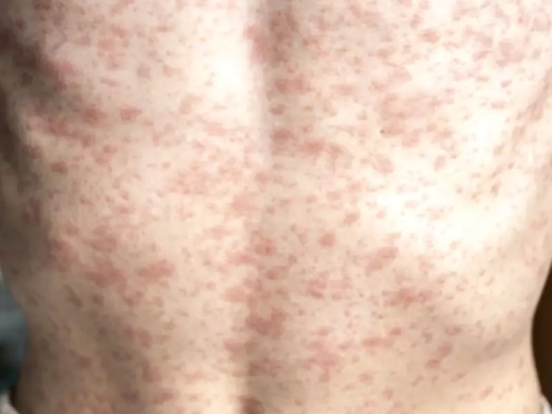 PAHO Urges Canada to Strengthen Measles Vaccination Amid Rising Cases