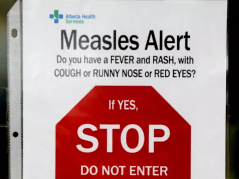 Parkland County Added to Alberta's Standing Measles Exposure Alert List