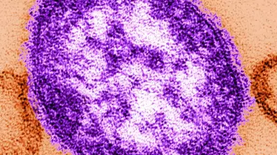Measles Cases Surge in Manitoba, Officials Issue Exposure Warning