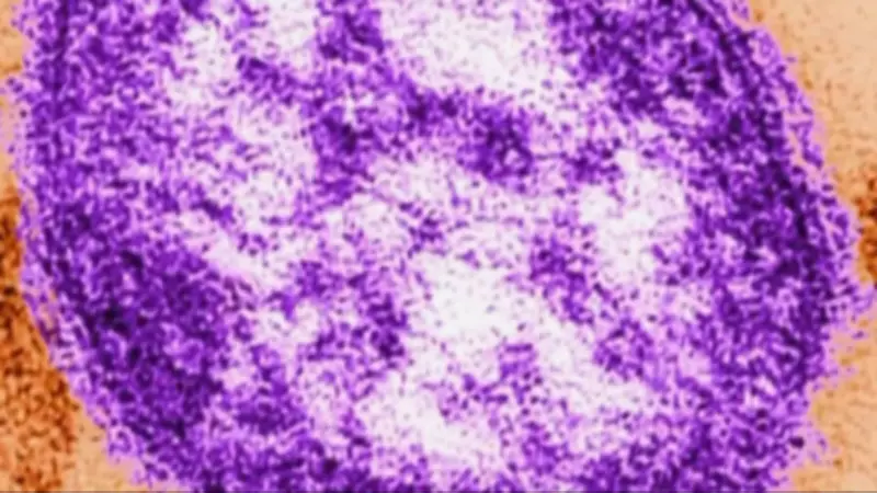 Alberta Health Issues Measles Alert After Infected Individual Travels Through Calgary Airport