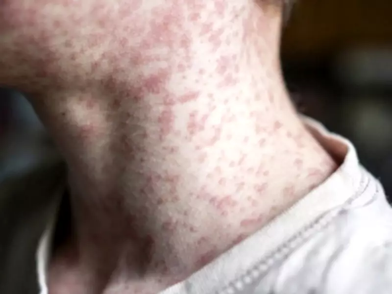 Alberta Health Services Issues Measles Exposure Alert Across Multiple Cities