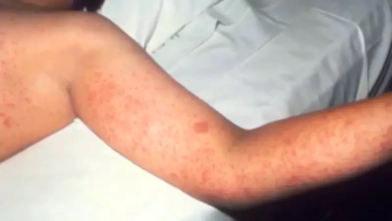 Measles Alert: Multiple Winnipeg Locations Identified as Potential Exposure Sites