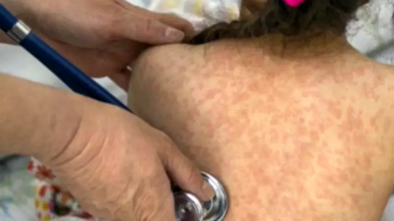 Measles Case Confirmed at Spruce Grove Catholic School in Alberta