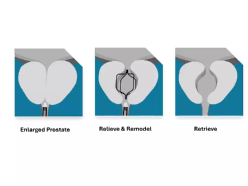 Prodeon Medical's Urocross System Receives FDA Clearance for BPH Treatment