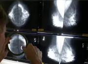 Global Breast Cancer Cases Projected to Surpass 3.5 Million by 2050, Study Warns