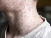 Measles Exposure Alert at University of Alberta and Stollery Hospitals in Edmonton