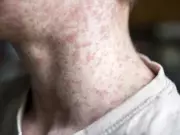 Quebec's Measles Outbreak Ends as National Cases Rise, Sparking Health Concerns