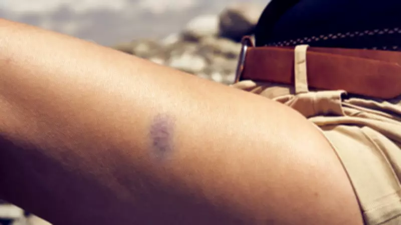 ADHD and Mystery Bruises: How Spatial Awareness Differences Lead to Frequent Bumps