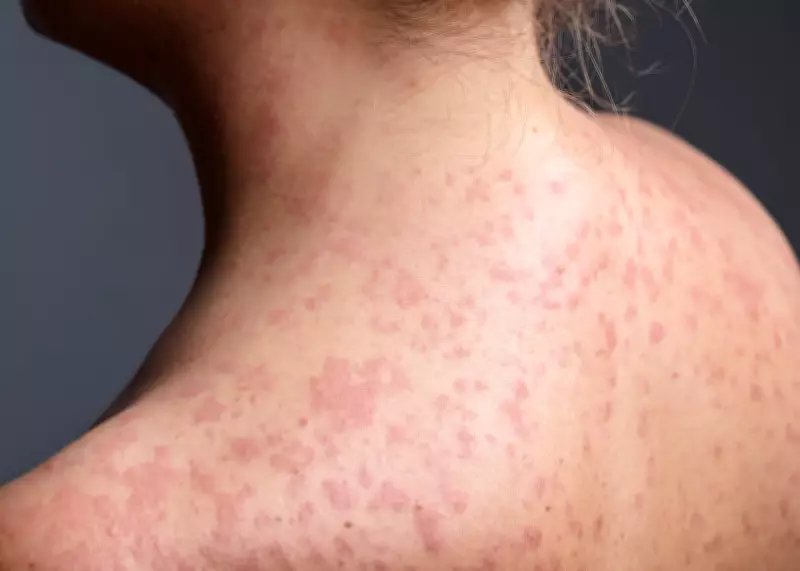 Measles Case Confirmed in Quebec City, Public Health Issues Alert