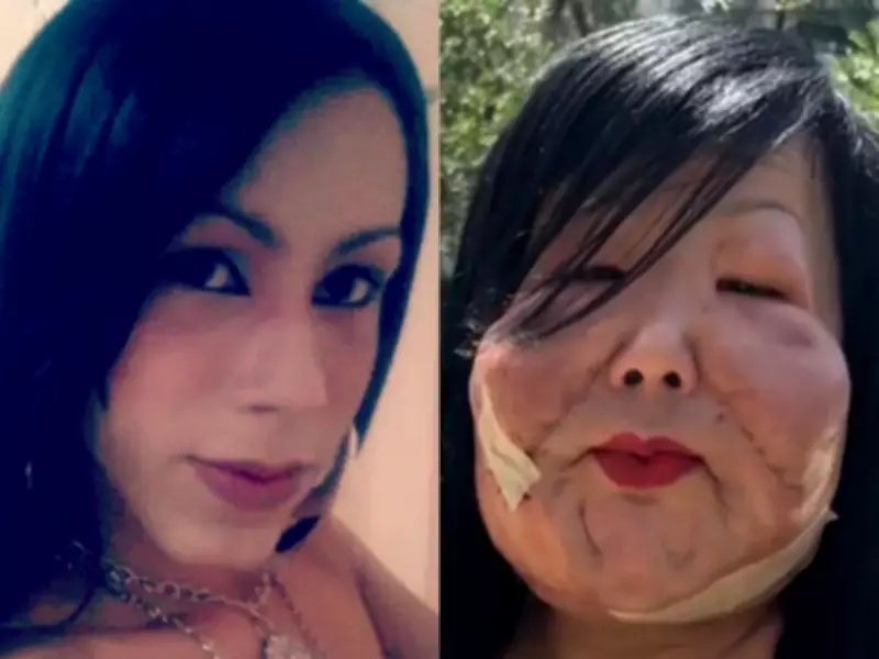 Transgender Influencer Undergoes Breast Surgery After Botched Fillers
