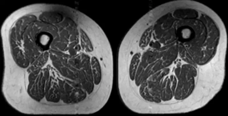 Ultraprocessed Foods Linked to Unhealthy Fat Deposition in Human Thighs