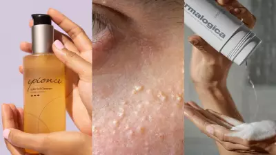 Expert Dermatologist Reveals Top Products to Prevent Milia Skin Condition