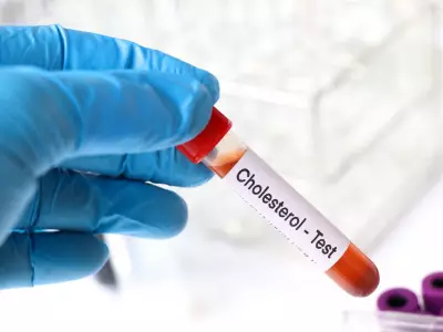 Updated Heart Guidelines Lower LDL Thresholds, Urge Earlier Screening