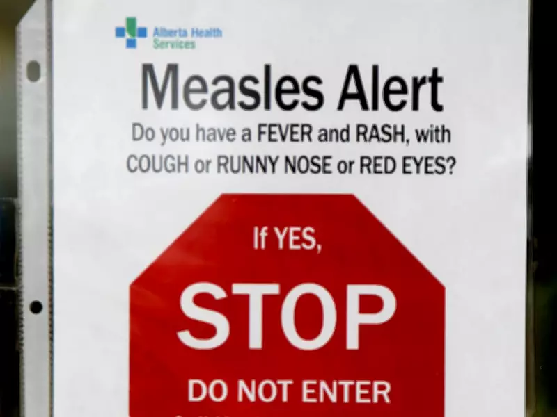 Measles Exposure Alert Issued for Calgary Hospital Emergency Departments