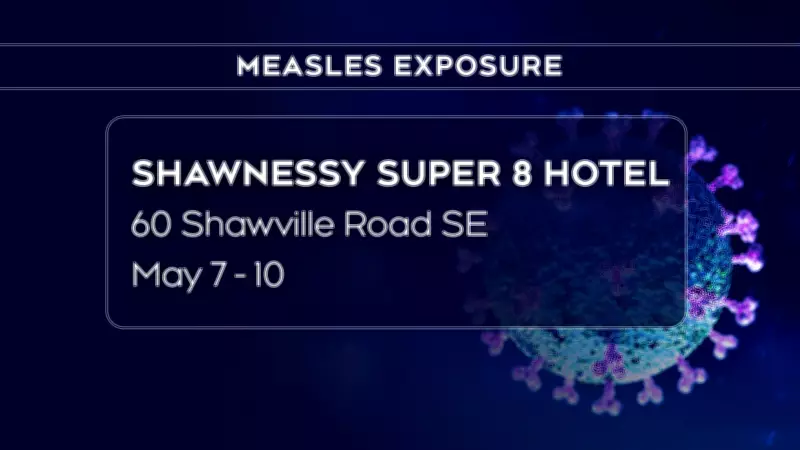 Measles Exposure Alert Issued in Calgary by Alberta Health Officials
