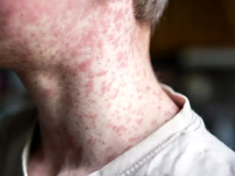 Toronto Public Health Warns of Measles Exposure in West End Locations