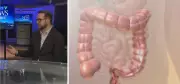 Barrie Ontario Lowers Colon Cancer Screening Age to 45