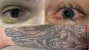 Tattoo-Related Uveitis: New Study Links Ink to Vision Loss