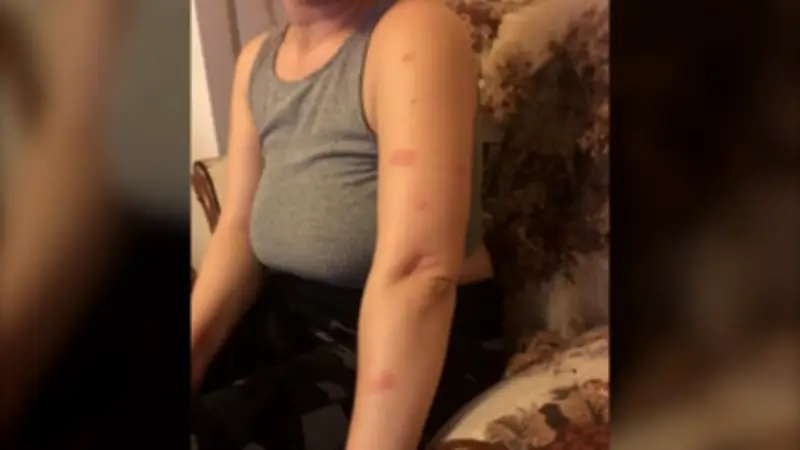 Calgary Woman Alleges Housing Authority Mishandled Bed Bug Infestation