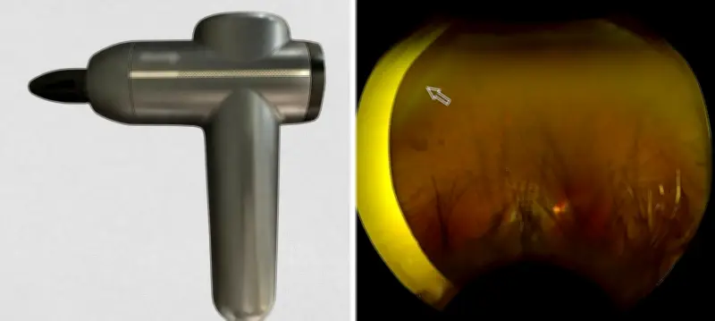 Massage Gun Use on Eyes Linked to Retinal Tears, Doctors Warn