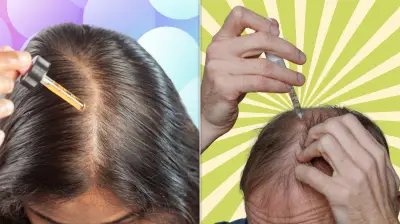 Minoxidil for Hair Loss: Dermatologists Warn Against Preventive Use