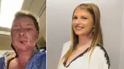World-First Biological Treatment Saves Woman Burned in London Frat Fire