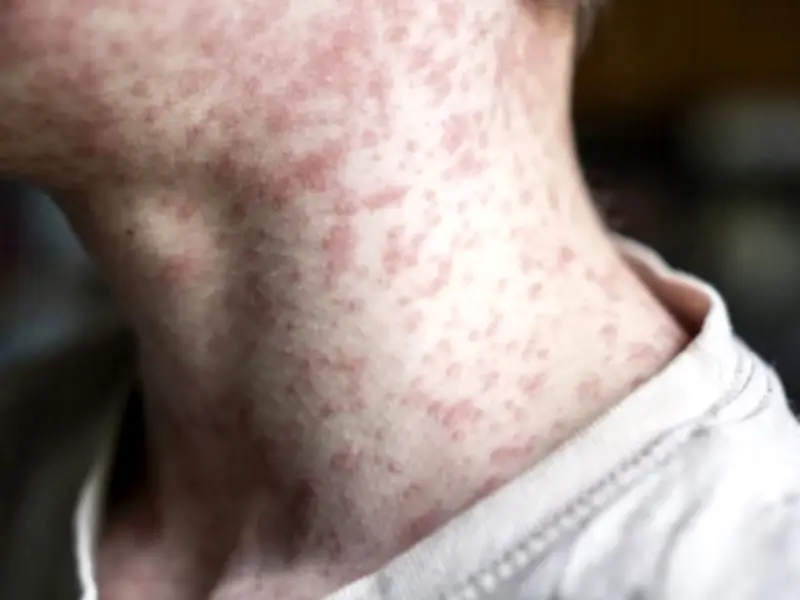Toronto Public Health warns of measles exposures in Scarborough